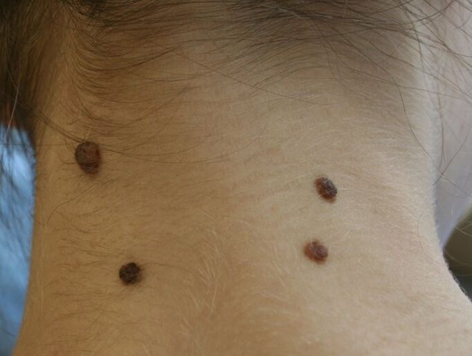 what do papillomas on the neck look like