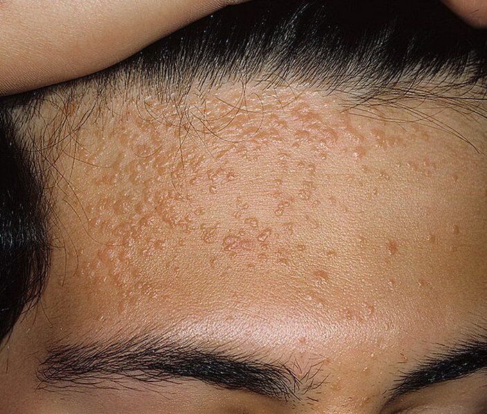 Flat papillomas on the forehead