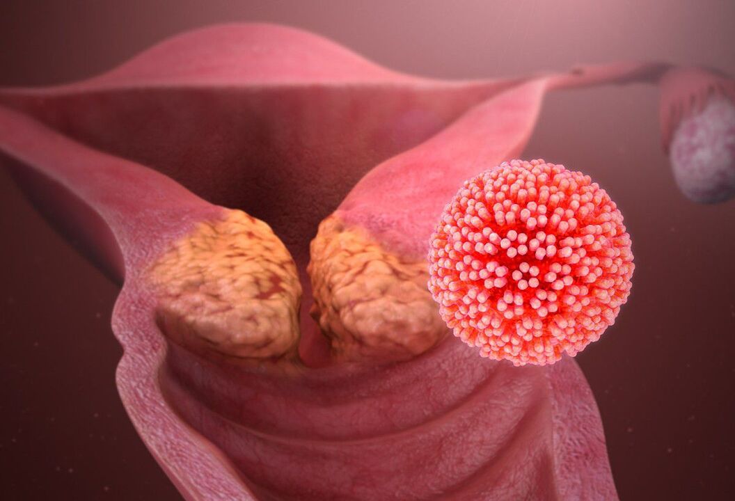 HPV injury of the cervix
