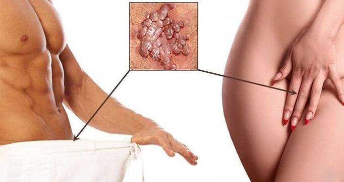 Warts in the genital area of ​​men and women