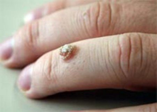 the wart on the finger