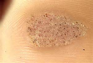 the wart on the skin