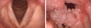Papillomavirus in the mouth