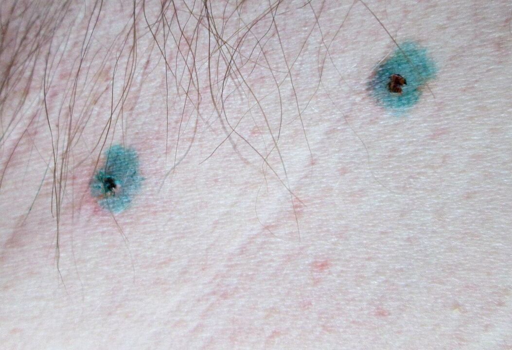 Marks on the skin after laser removal of papillomas