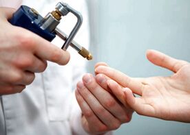 Removing a wart on a finger using liquid nitrogen
